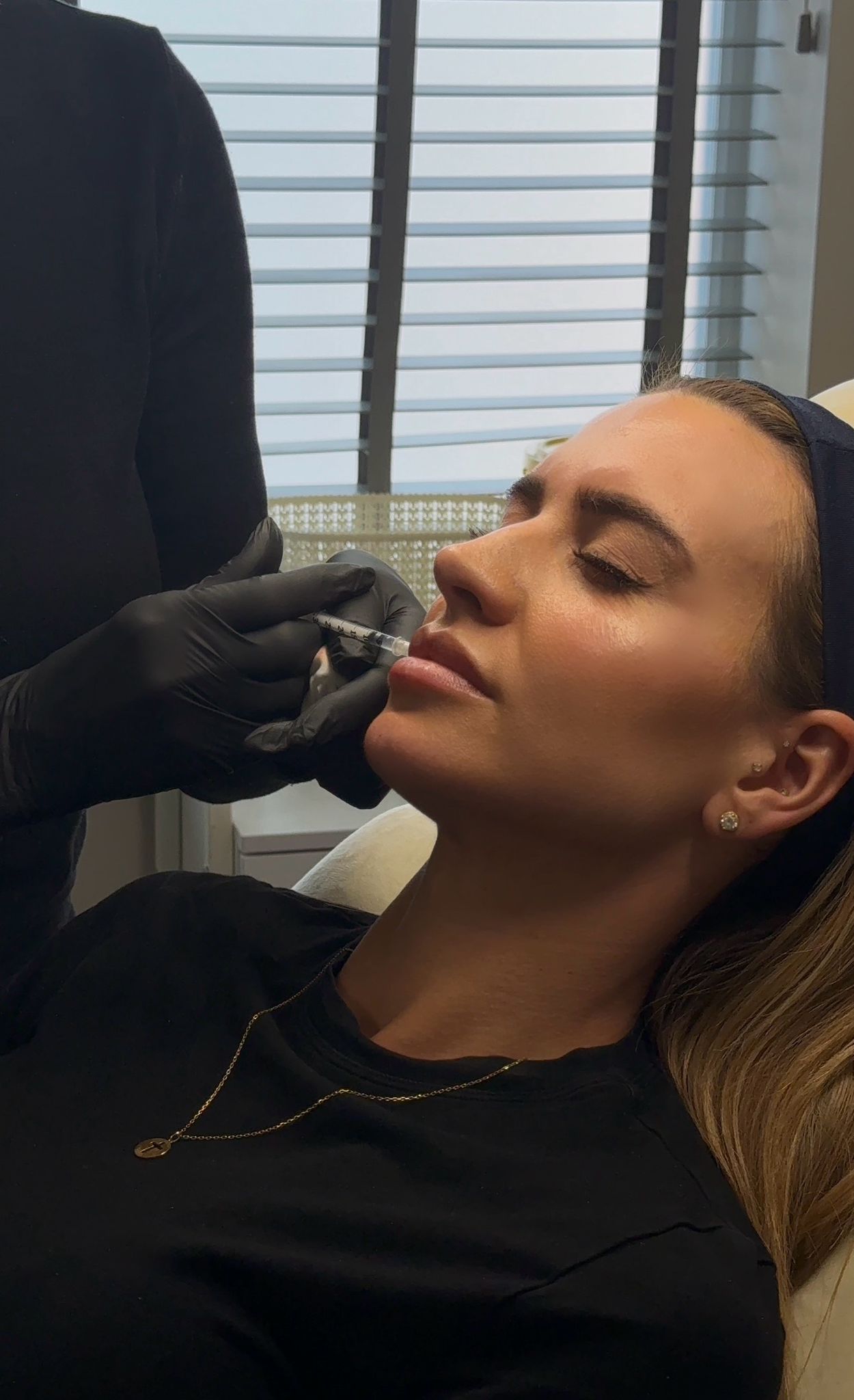 Dermal filler treatment by Julie Brown